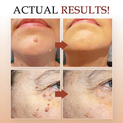Tags & Moles Remover (Buy 1 Get 1 Free🔥🔥)